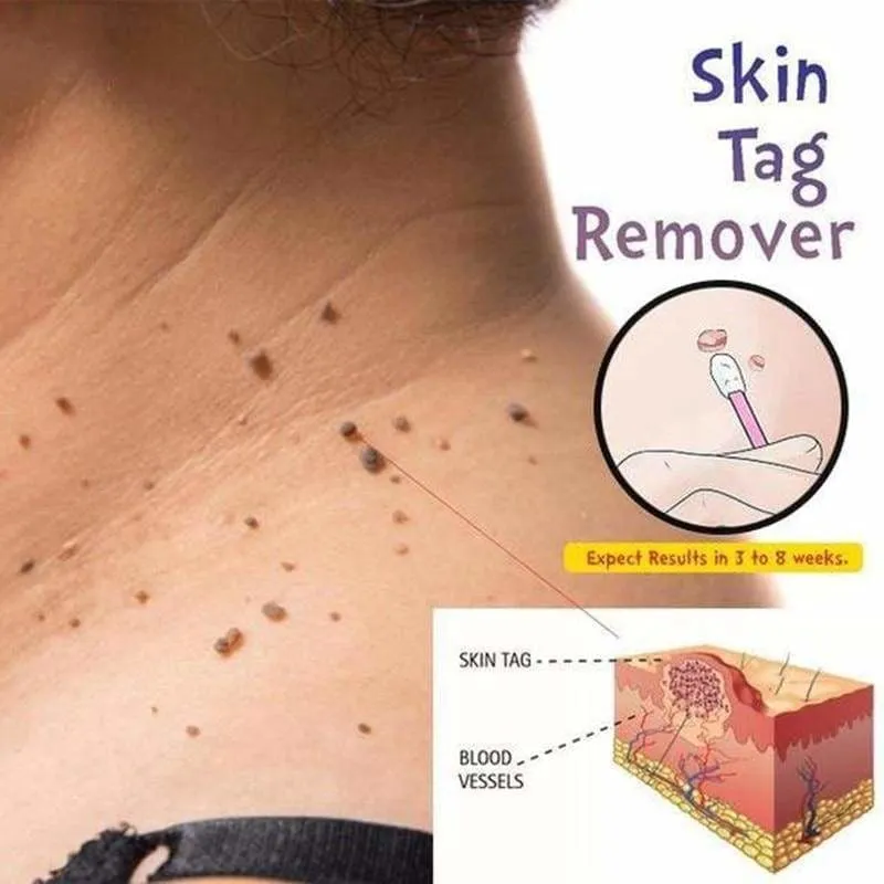 Skin Tag Mole Wart Remover